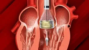 TAVI/TAVR
