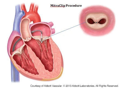 TMVR/MITRACLIP
