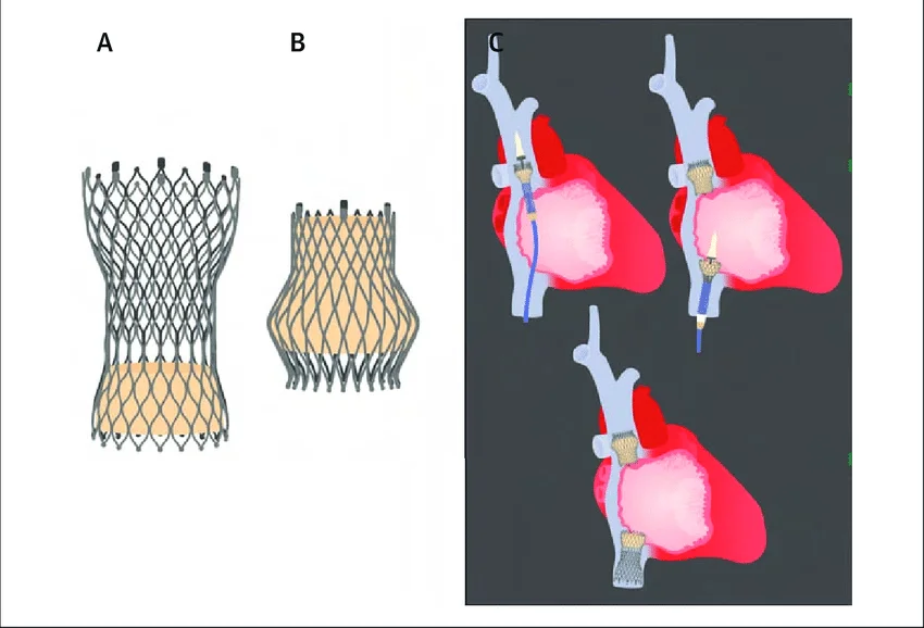 TRICVALVE
