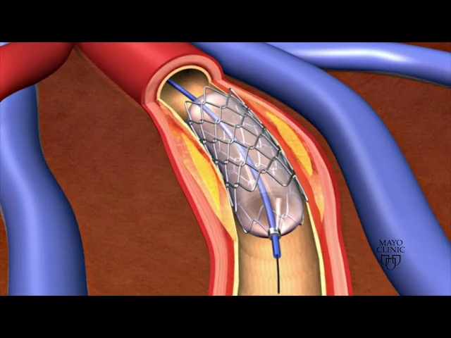 ANGIOPLASTY & STENTING