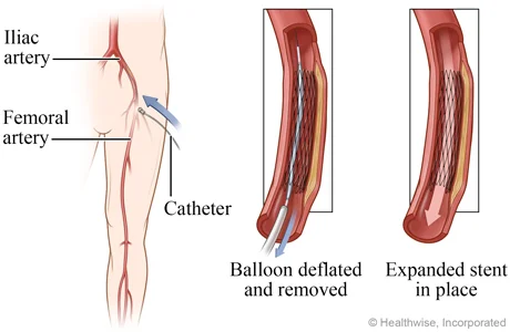 PERIPHERAL ANGIOPLASTY