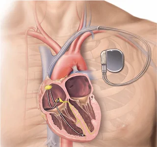 PACEMAKER